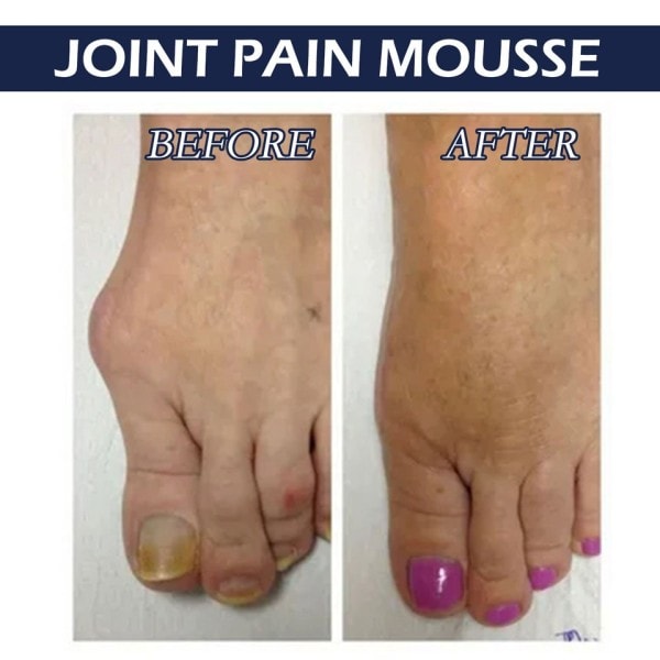 Anti Arthritis Mousse Creme Behandling Skulder Nakke Muskel led Smerte Salve