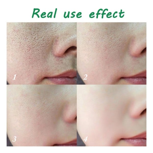Acne Behandling Creme Pore Shrink Olie Kontrol Hviding Reparation Bums Dyb rengøring Anti-acne Fugtighedscreme