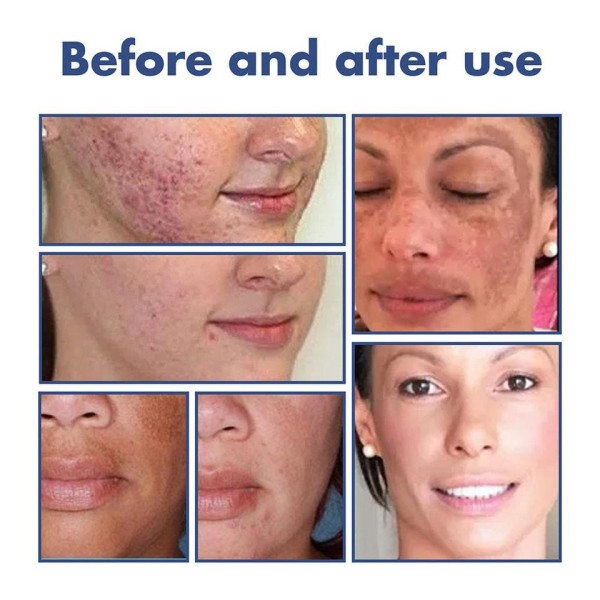 Whitening Facial Cleanser Brighten Hud Tone Forfriskende Fade Spot Chloasma Fjernelse