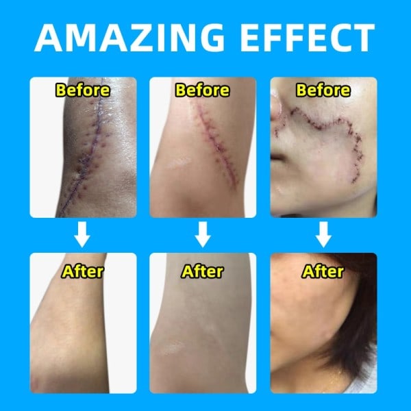 Ar fjernelse creme gel fjern acne pletter behandling stræk mærker forbrænding kirurgi ar reparation creme