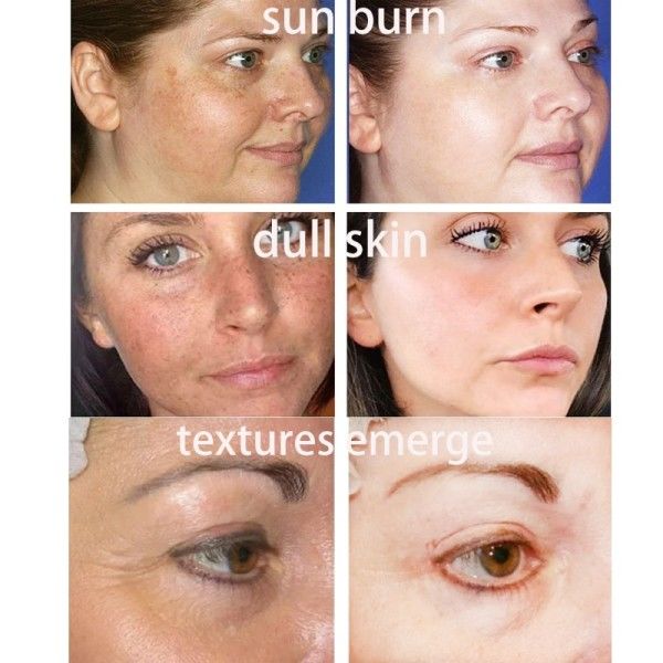 Spot Whitening Serum Lightening Lightening Hyperpigmentering Kloasma Mörka Fläckar