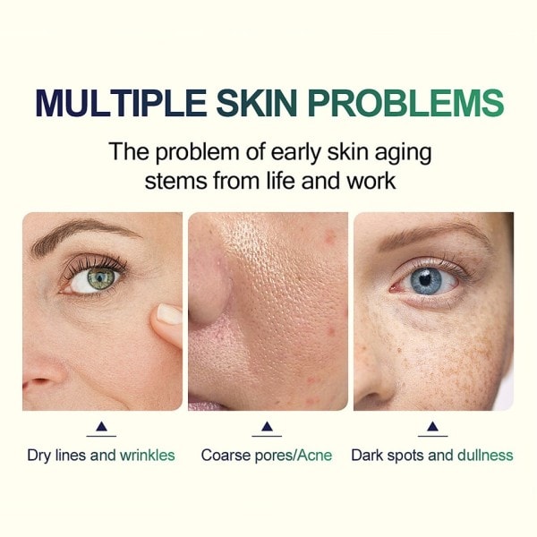 30ml TCA Kemisk Peel 70% Tca Peel Acid Peeling Acid neutralizer set hud Superforce Peeling Pigmentation