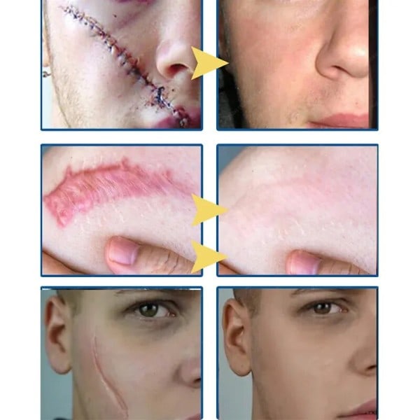 Ar fjernelse creme effektiv behandling stræk mærker forbrænding fade acne pletter sektion ar gel