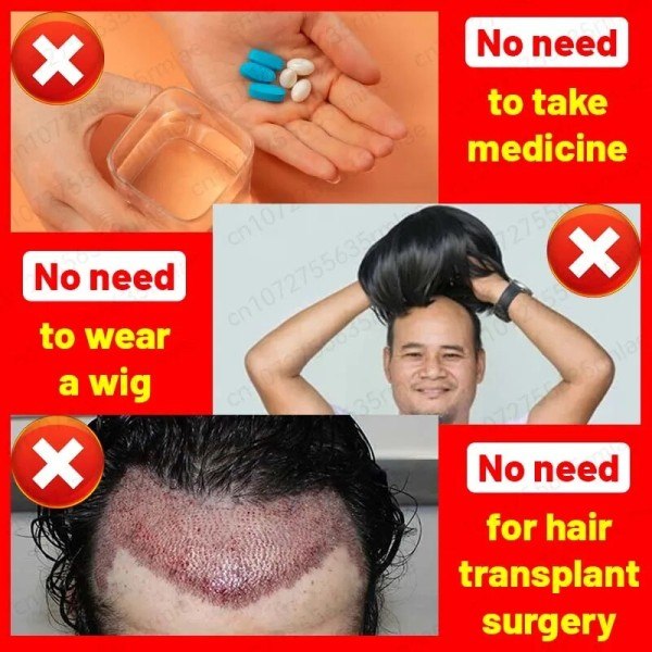 Nopea hiusten kasvua edisti tuotteet hiusten lähtö perinnöllinen seborrooinen alopecia hoito öljy