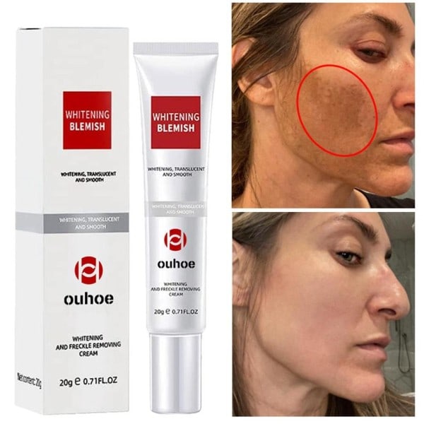 Effektiv ta bort mörk fläck ansikte kräm vitning freckle kräm
