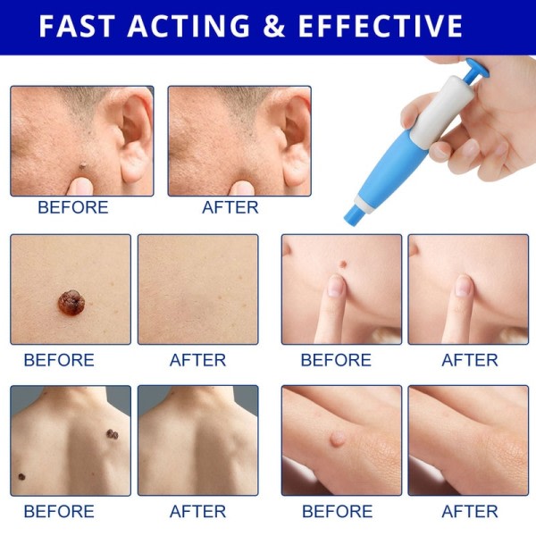 Hud Tag Remover Kit Mulvad Vårta Remover Utrustning Skin Tag Behandling Verktyg