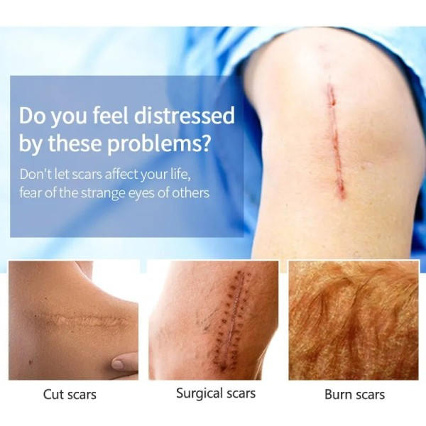 Recovery Ar Cream Hurtig Fjernelse Stræk Mærker Forbrændinger Keloider Behandling Kirurgi Ar Pigment Urte Reparation Hud Ar Glat Gel