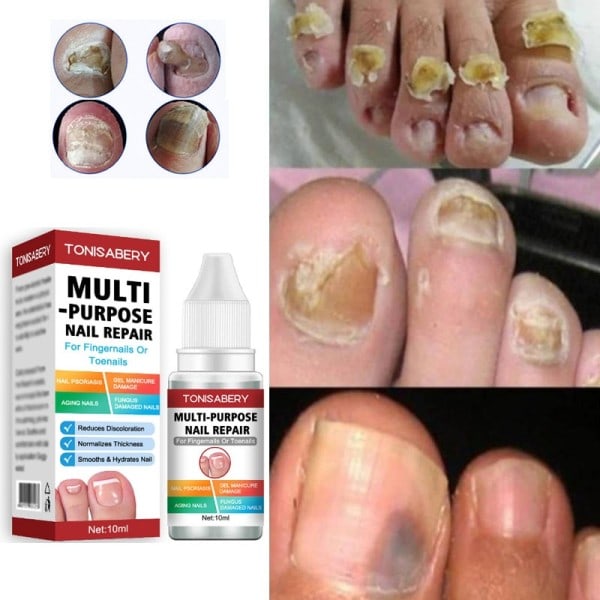 Nagel svamp behandling essens anti infektion fötter nagelband ta bort