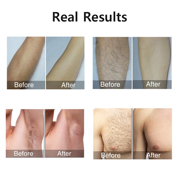 Blinker  Epilator Hårfjerning for Kvinder Mænd Krop Ben Armhulen Smertefri IPL Permanent Depilator