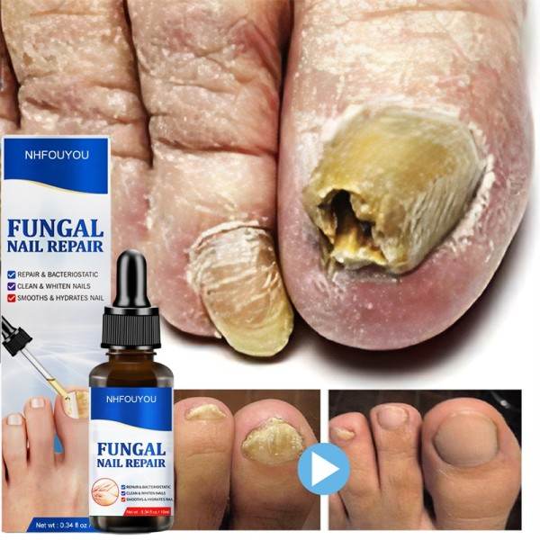 Svampe negle behandling olie fod reparation essens tå negle svamp fjernelse gel anti infektion creme