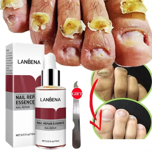 Negle svamp behandling essens serum hånd pleje fod svamp fjernelse reparation gel