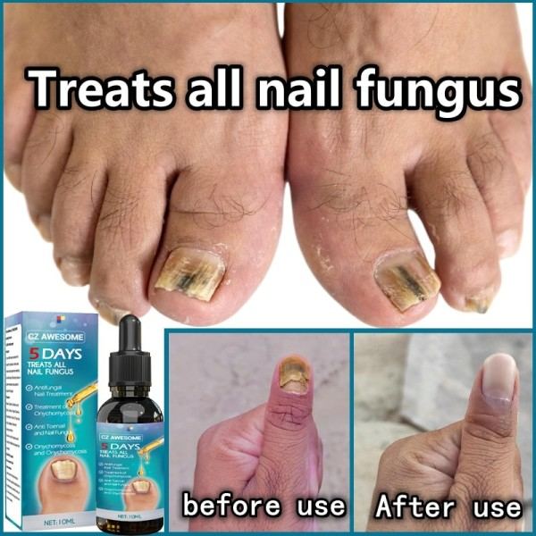Manicure Fod Pleje Essence Negle Fod Hvidning Tånegle Svamp Fjernelse Gel
