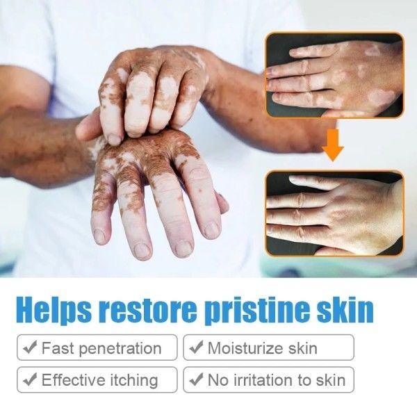 Urte ekstrakt vitiligo salve fjern ringorm hvite flekker fjerning leukoplakia behandling krem
