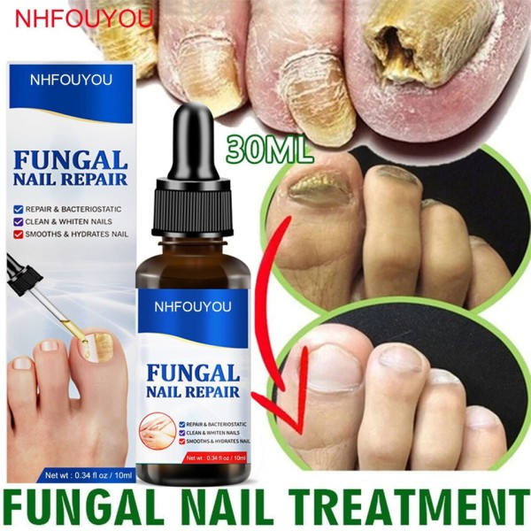 Svampe negle behandling olie fod reparation essens tå negle svamp fjernelse gel anti infektion creme