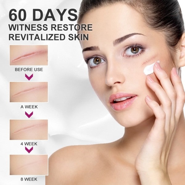 Fade Är Stretch Marks Remover Cream Skin Repair Ansikte Cream Acne Fläckar Acne Behandling