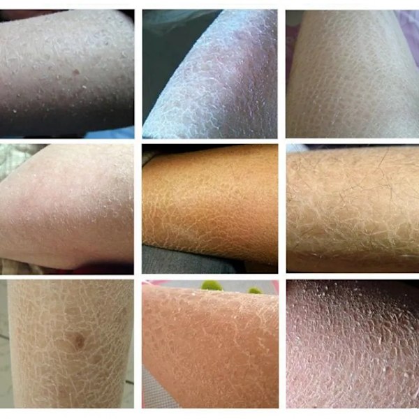Reparer Kylling Skin Cream Curing Kropp Mørk Flekk Keratose follikkel Pilaris  Fjern