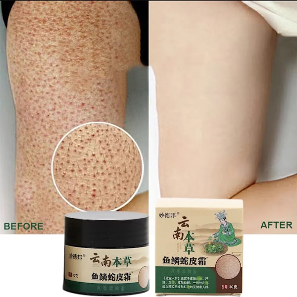Reparer Kylling Skin Cream Curing Kropp Mørk Flekk Keratose follikkel Pilaris  Fjern