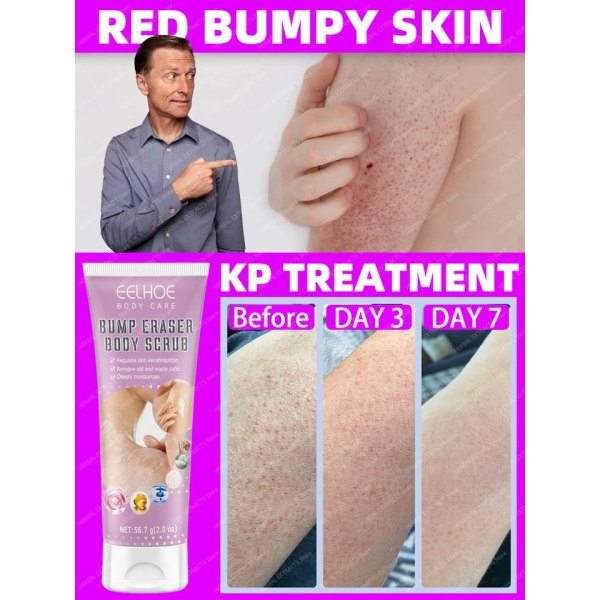 Pilaris Behandling Jordbær Bein Fjerning Bumpy Rough Kylling Skin Fjerner Cream