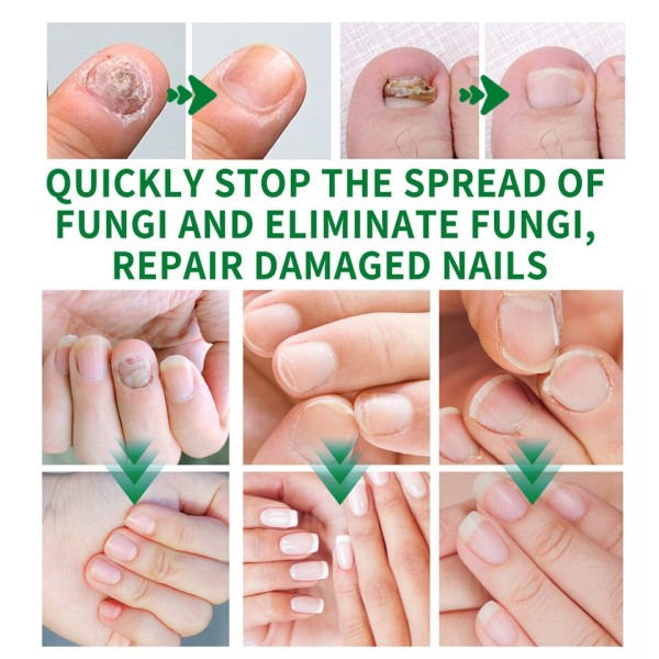 Manicure Fod Pleje Essence Negle Fod Hvidning Tånegle Svamp Fjernelse Gel