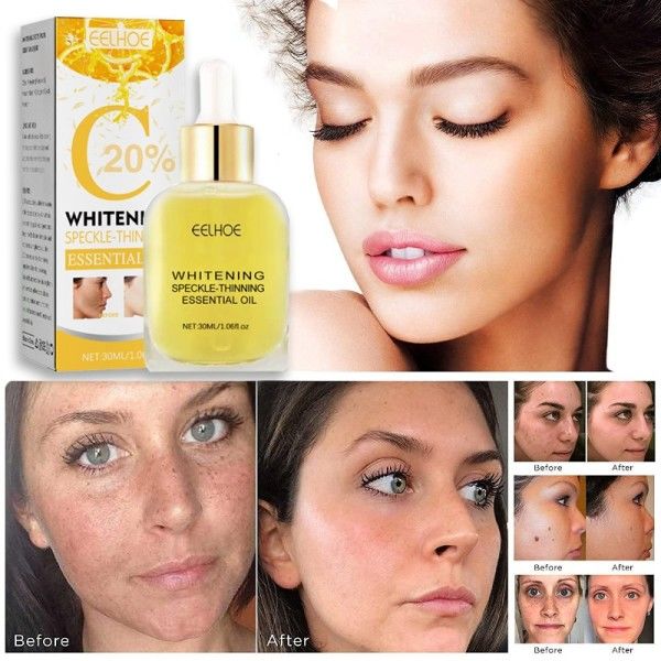 Spot Whitening Serum Lightening Lightening Hyperpigmentering Kloasma Mörka Fläckar