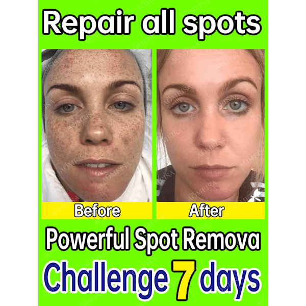 Mørke flekker fjerner for ansikt sol melasma fregner pigment alder flekker fjerning