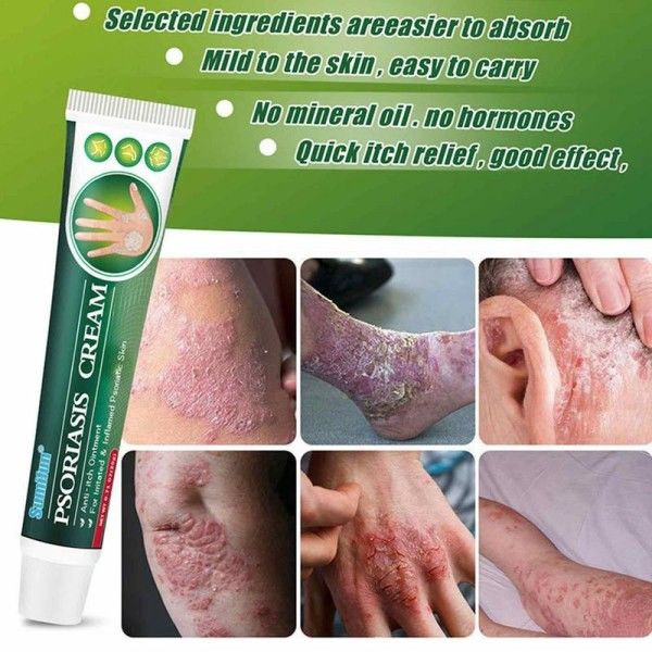 Hud creme Anti-kløe salve hud effektiv udslæt creme lindrer kløende hud mos creme
