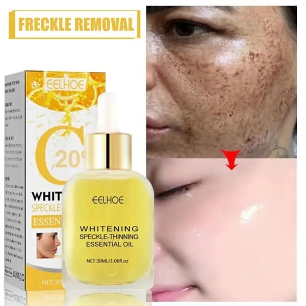 Mørke plet fjerner til ansigt sol melasma fregner pigment alder pletter fjernelse