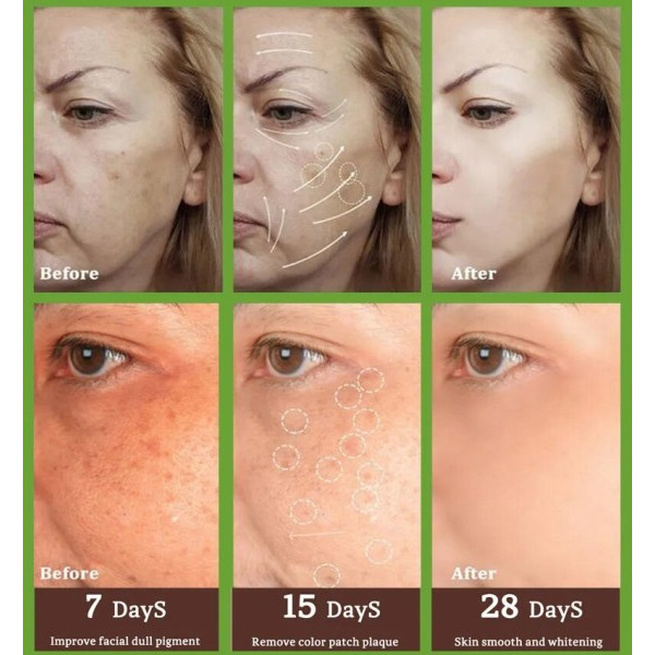 Fregner fjerning essens fjern ansiktsplekker hud mørk flekk fjern melasma flekker solflekker bleking og fregner fjerning krem