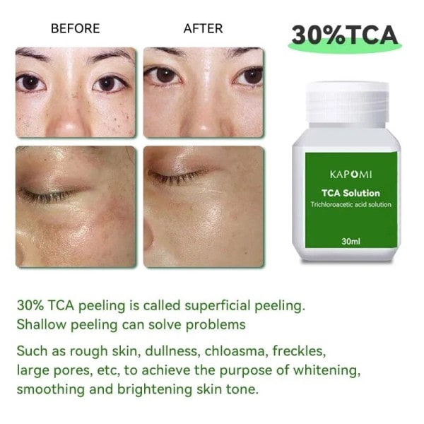 Peel Professional Grad Syra Peeling Tar bort Tatuering Ålder Fläckar Stretch Marks Gul Peeling Olja