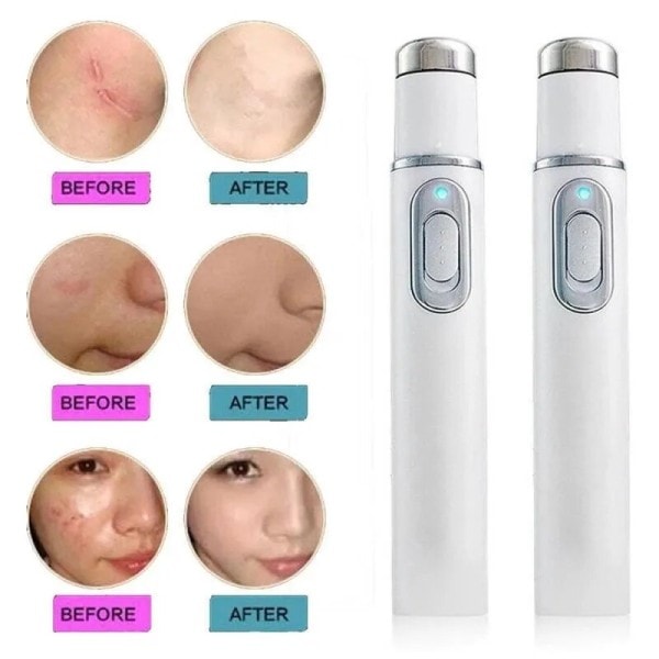 Blå Lys Ansigtsbehandling Maskin Acne Rynke Fjernelse Laser Pen Hud Pletter Fjernelse Anti Skrampe Spider Vene Eraser