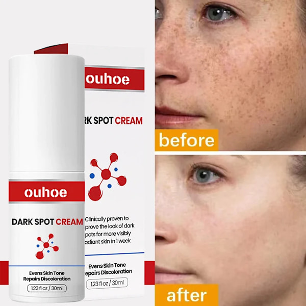 Ta bort Mörka Fläckar Snabb Ljusna upp Förbättra Matthet  Effektiv Bletning Freckles Hudvård