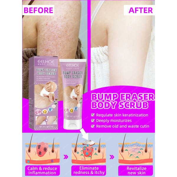 Pilaris Behandling Jordbær Bein Fjerning Bumpy Rough Kylling Skin Fjerner Cream