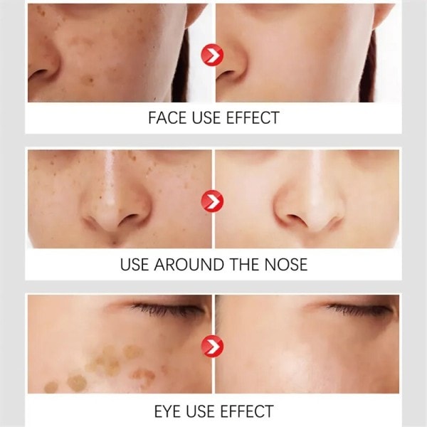 Mørke plet fjerner til ansigt sol melasma fregner pigment alder pletter fjernelse