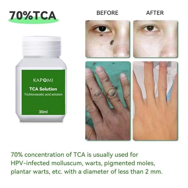 Peeling Peeling Acid Skin Super Force Yellow Peeling Olie Pigmentation Acne Ar