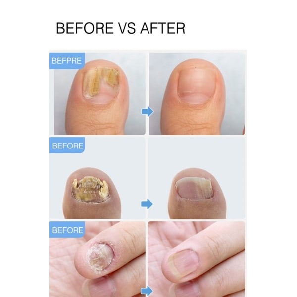Bedste Fod Reparation Negle Set Anti Infektion