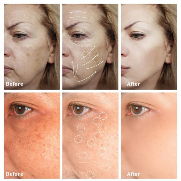 125ml Kojic Sen Concentre Med Collagen Serum Strong Lightening Fade Sta Mørke flekker
