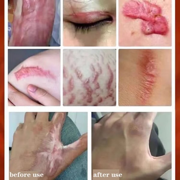 Urte ar fjernelse creme stretch mærker gel reparation pock mærke forbrænding kirurgisk ar fjerner