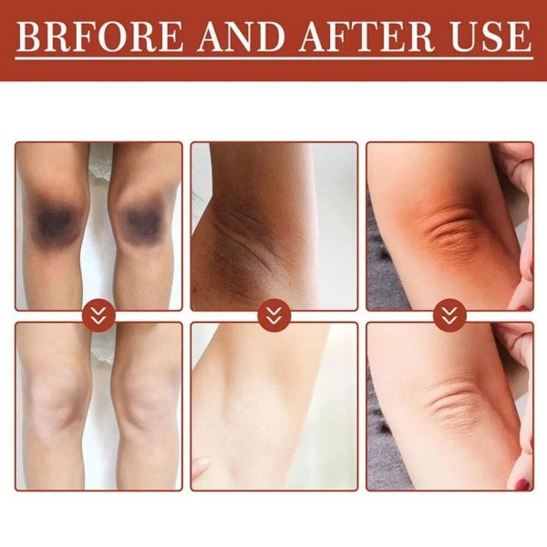 30ml Peeling Olie Albue Knæ Finger Sort Gul Olie Til Hud Lysning Fugtgivende Fjerner døde