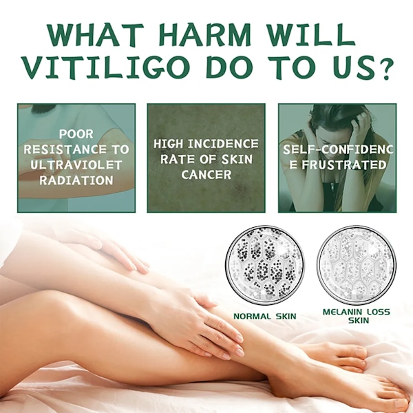 Effektivt vitiligo reparation salve urte fjernelse ringorm hvid plet creme fjern få kvit af hud