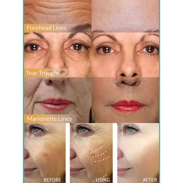 Anti mørke plet Fjern fregner chloasma hyperpigmentering blegning lys alder sol Melasma Kloasma Fjerner æterisk olie