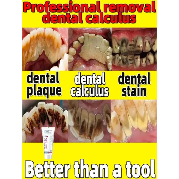 tand tandsten fjerner blegning tænder mund lugt fjernelse dårlig ånde Forebyggelse Periodontitis