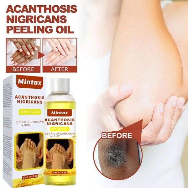 30ml Peeling Olie Albue Knæ Finger Sort Gul Olie Til Hud Lysning Fugtgivende Fjerner døde