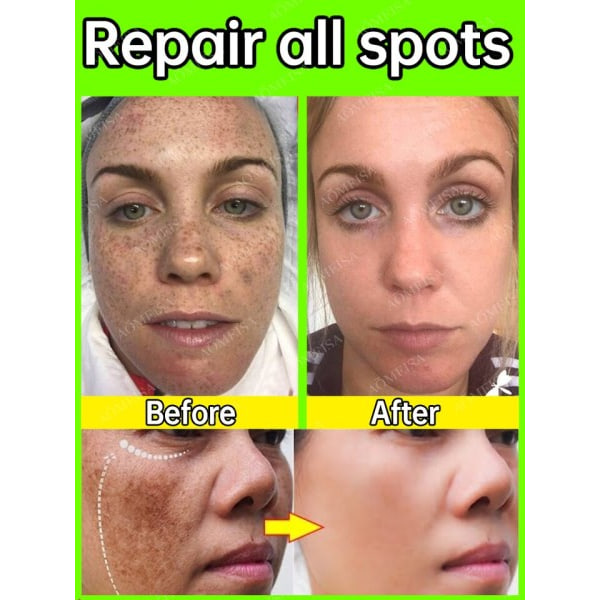 Mørk plet fjerner til ansigt fjern melasma fjernelse depigmentering
