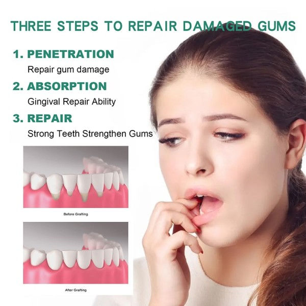 Tannkjøtt Gjenvekst Dråper Lindring Munn Periodontal Gummi Blødning Smerte Behandling
