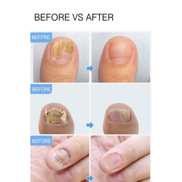Reparation Negle Svamp Behandling Essence Fod Pleje Serum Tå Negle Svampe Fjernelse Gel