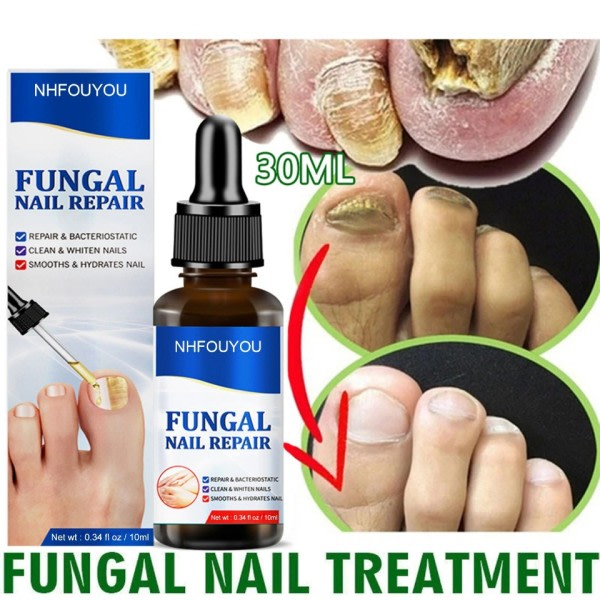 Svampe negle behandling olie fod reparation essens tå negle svamp fjernelse gel anti infektion creme