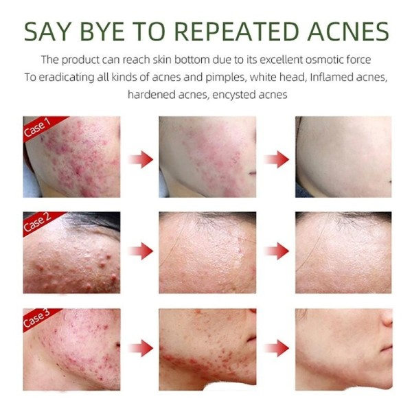 Acne Behandling Serum Återfuktande Närande Torrt Ansiktsvård Firming Shrink Porer Oil Control Multi-effect Skin Essence