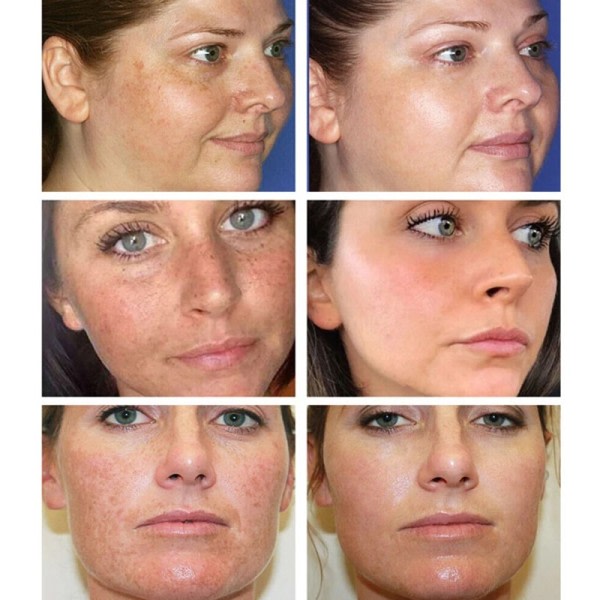 Ansigtsbehandling pletter hud mørk plet fjern melasma alder pletter solpletter hvidning og fregne fjernelse creme