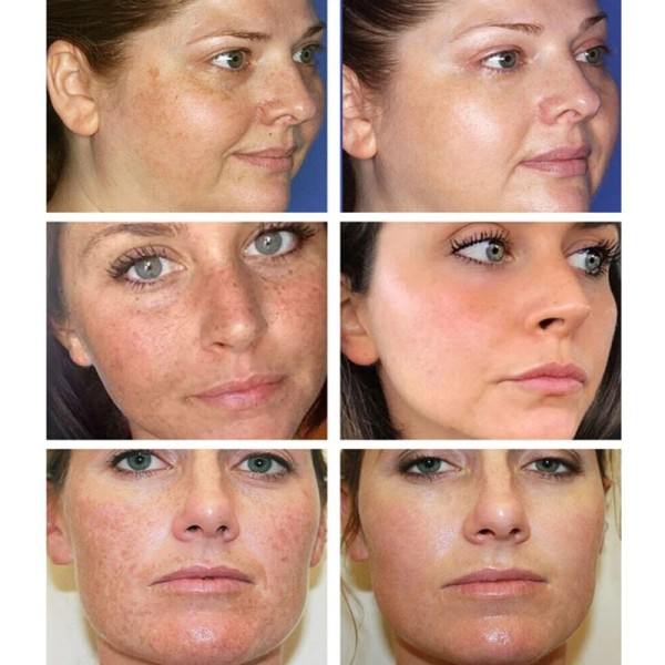 Ansikts flekker hud mørk flekk fjern melasma alder flekker solflekker bleking og fregne fjerning krem