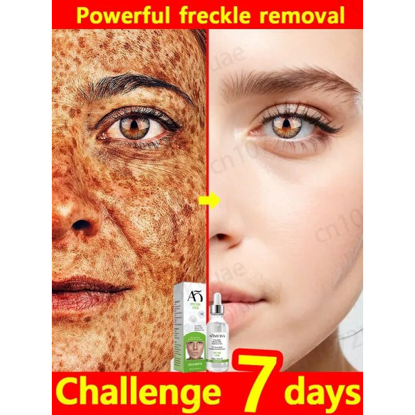 Fregner creme fjerner fregner chloasma mørke pletter pigmentering alder pletter og pletter